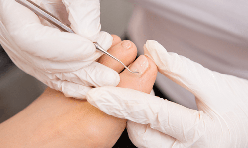 Ingrown Toenail Surgery | Brisbane | Carindale | Mt Gravatt